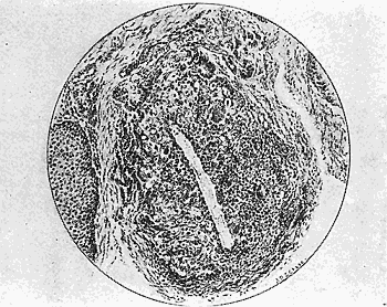 41b. Section through one of the nodules showing the caterpillar
hair. De Schweinitz and Shumway.