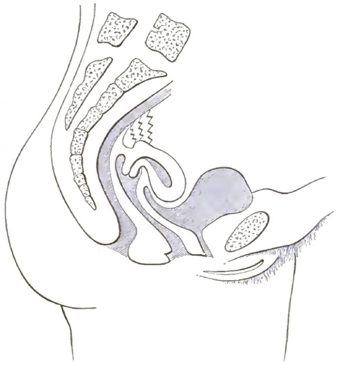 Anteflexion with postuterine fixation