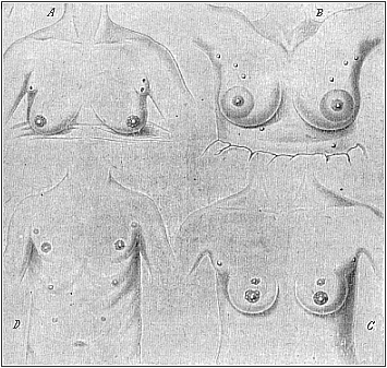 Fig.103, A, B. C, D. Instances of
redundant mammary glands and nipples (hypermastism).